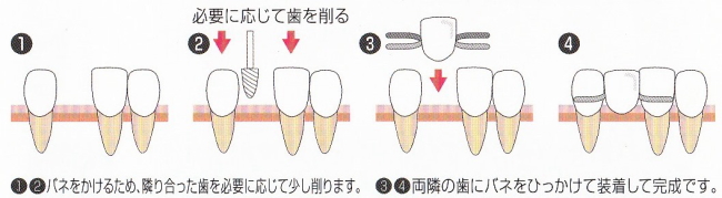入れ歯治療の流れ（取り外し式部分入れ歯の場合）