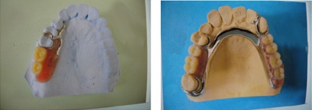 ミラクル義歯の特徴2