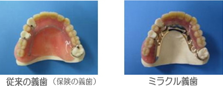 ミラクル義歯と従来の義歯（保険の義歯）