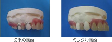 ミラクル義歯の特徴