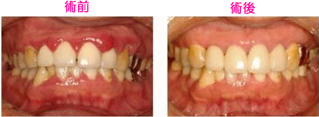 歯周内科治療による お口の中の変