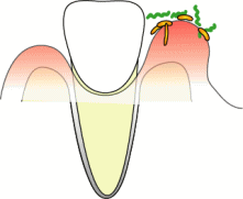歯周病菌が歯ぐきに炎症を起こす