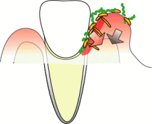 菌が歯と歯ぐきの間に入ってきます